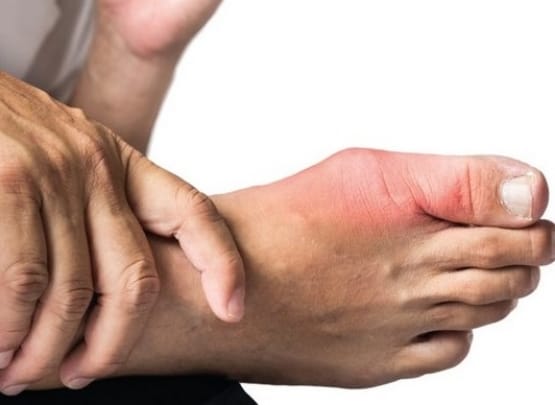 Gota: Tudo o que precisa de saber